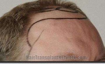 Hair restoration procedure results