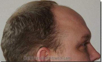 Hair restoration procedure results