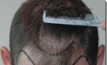 Hair restoration procedure results