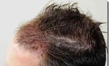 Hair restoration procedure results