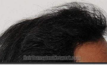 Hair restoration procedure results