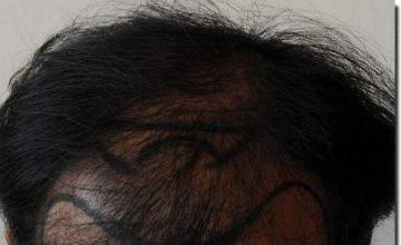 Hair restoration procedure results