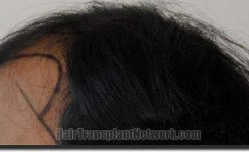 Hair restoration procedure results