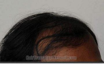 Hair restoration procedure results