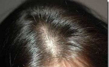 Hair restoration procedure results