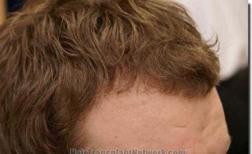 Hair restoration procedure results