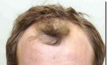 Hair restoration procedure results