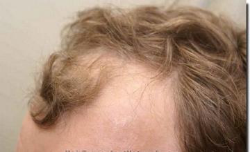 Hair restoration procedure results