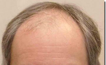 Hair restoration procedure results