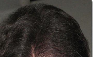 Hair restoration procedure results