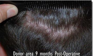 Hair restoration procedure results