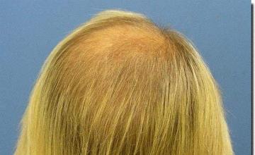 Hair restoration procedure results