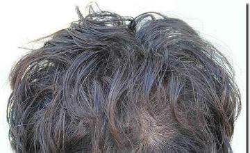 Hair restoration procedure results