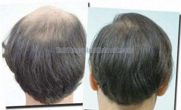 Hair restoration procedure results