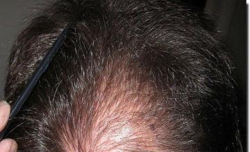 Hair restoration procedure results