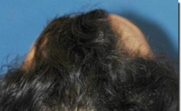 Hair restoration procedure results