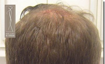 Hair restoration procedure results