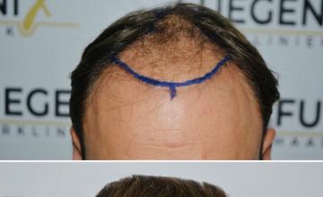 Hairline View 