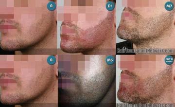 Beard transplantation surgery before and after pictures