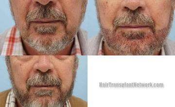 Front view - Before and after beard transplantation surgery