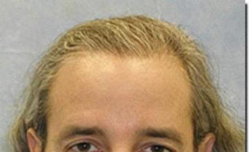 Hair restoration procedure results