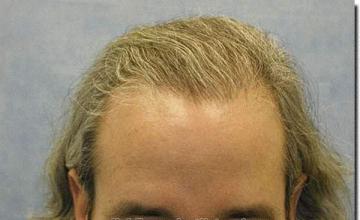 Hair restoration procedure results