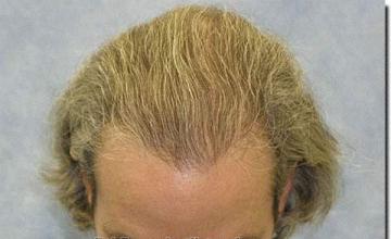 Hair restoration procedure results