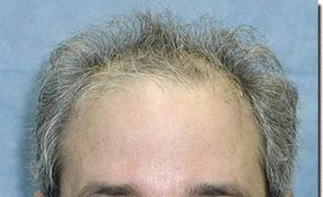 Hair restoration procedure results
