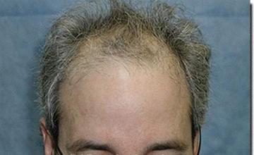 Hair restoration procedure results
