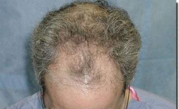 Hair restoration procedure results