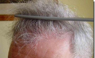 Hair restoration procedure results