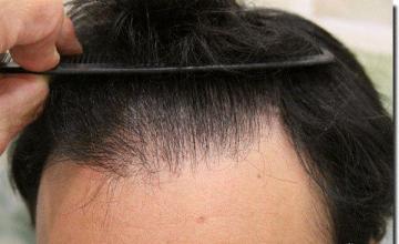 Hair restoration procedure results