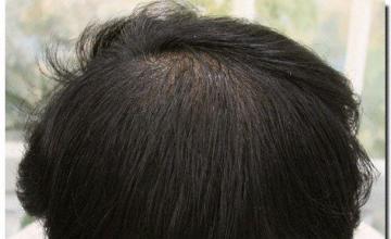 Hair restoration procedure results