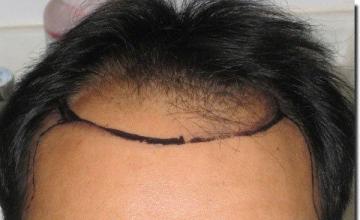 Hair restoration procedure results