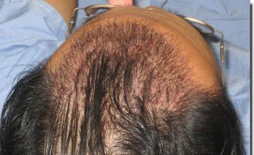 Hair restoration procedure results