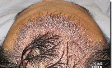 Hair restoration procedure results