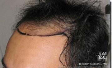 Hair restoration procedure results