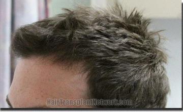 Hair restoration procedure results