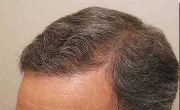 Hair restoration procedure results