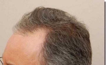 Hair restoration procedure results