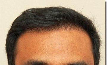 Hair restoration procedure results