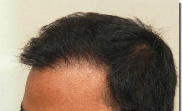 Hair restoration procedure results