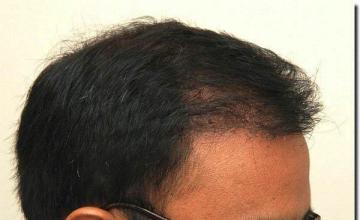 Hair restoration procedure results