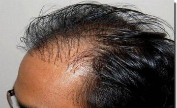 Hair restoration procedure results