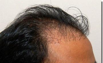 Hair restoration procedure results