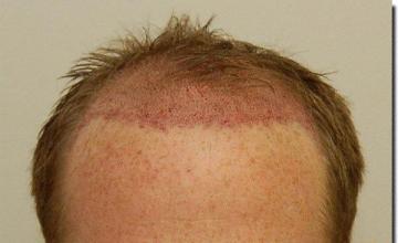 Hair restoration procedure results