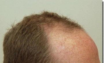 Hair restoration procedure results