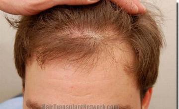 Hair restoration procedure results