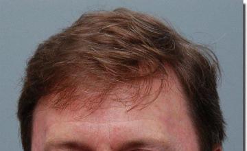 Hair restoration procedure results