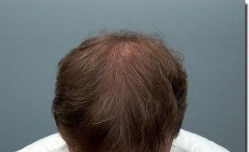 Hair restoration procedure results